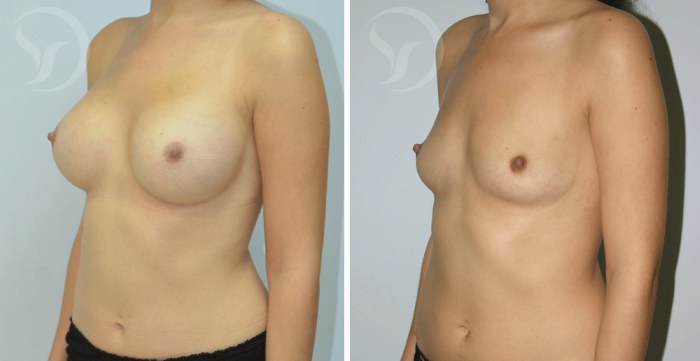 ניתוח הגדלת חזה תמונות לפני ואחרי