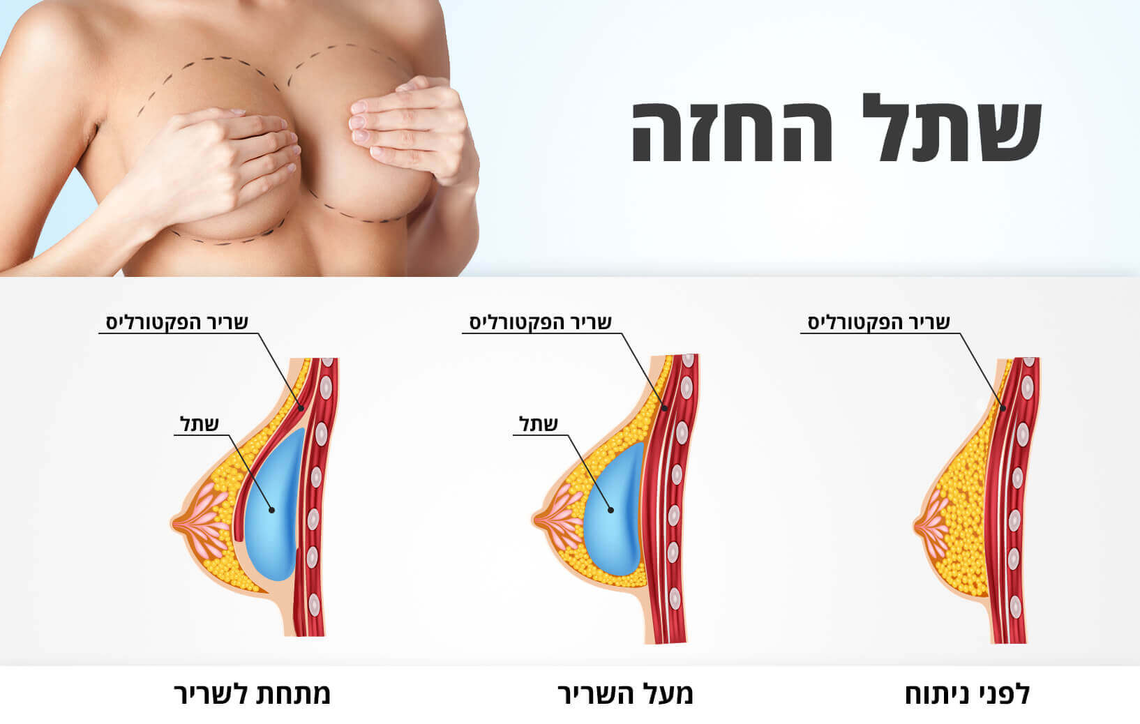 אילוסטירציה של הנחת השתל מעל השריר או מתחת