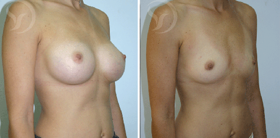 הגדלת חזה עם שתל אנטומי לפני אחרי