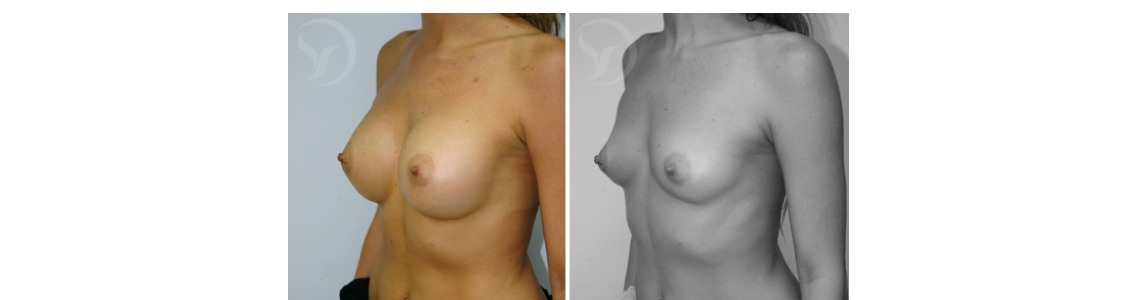 הגדלת חזה עם שתל אנטומי דר נועם חי