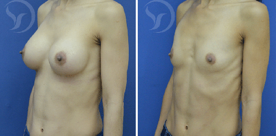 הגדלת חזה עם שתל אנטומי לפני ואחרי