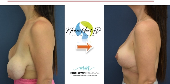 הוצאת שתלים והרמה דר נועם חי 1