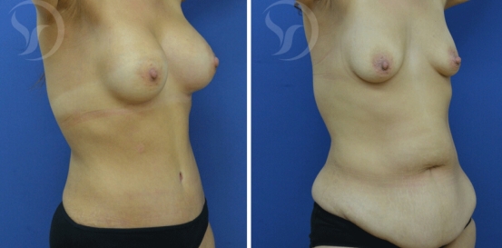 מתיחת-בטן-ושאיבת-שומן-לפני-ואחרי-אלכסון-43