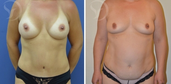 מתיחת-בטן-ושאיבת-שומן