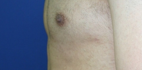 הקטנת חזה לגבר