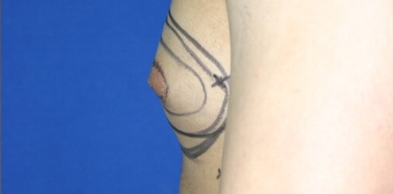 הקטנת חזה לגבר