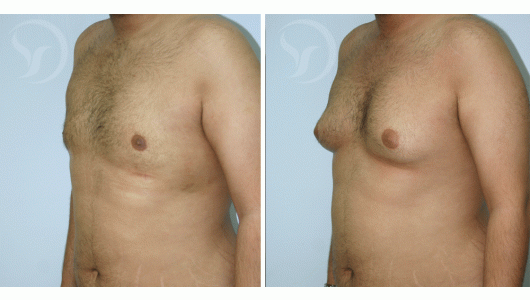 ניתוח גניקומסטיה לפני ואחרי