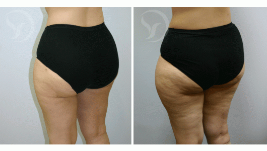 ניתוח שאיבת שומן ברגליים לפני ואחרי