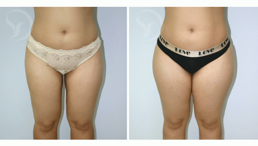 ניתוח שאיבת שומן לפני ואחרי