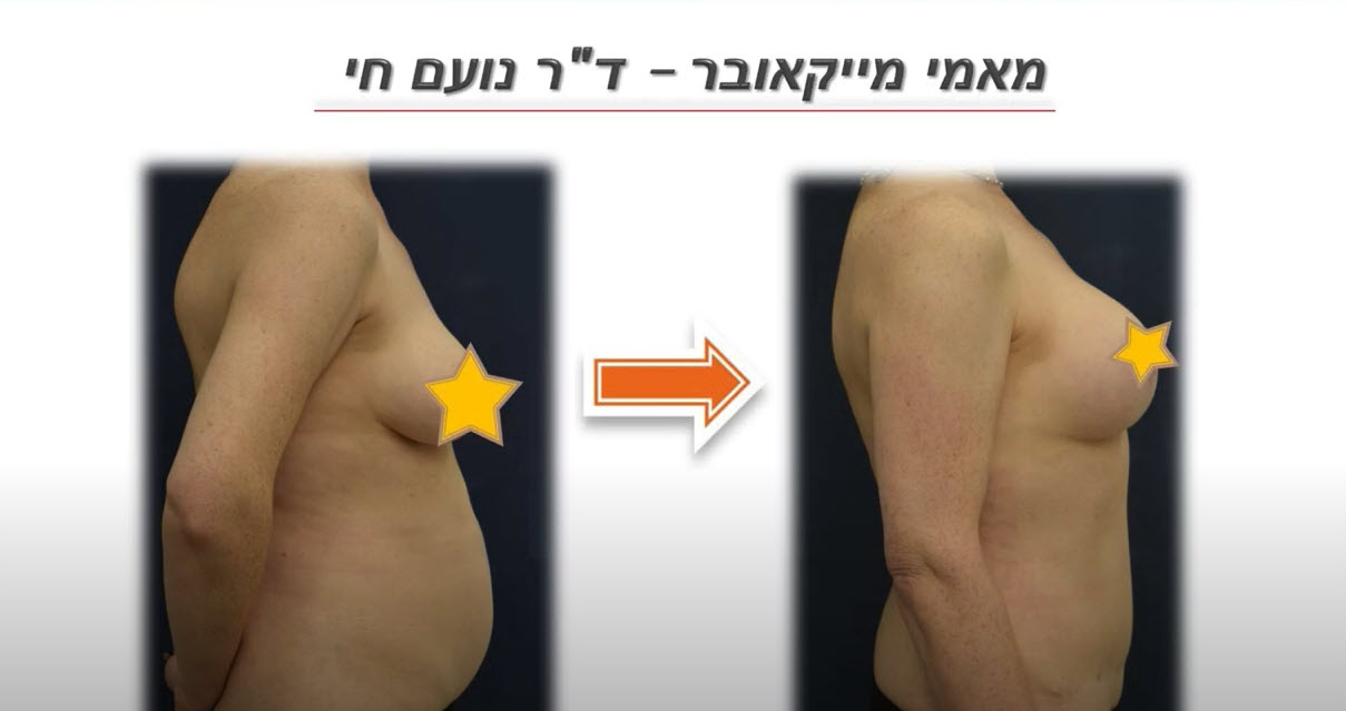 ד''ר נעם חי בראיון על טיפול מאמי מייקאובר