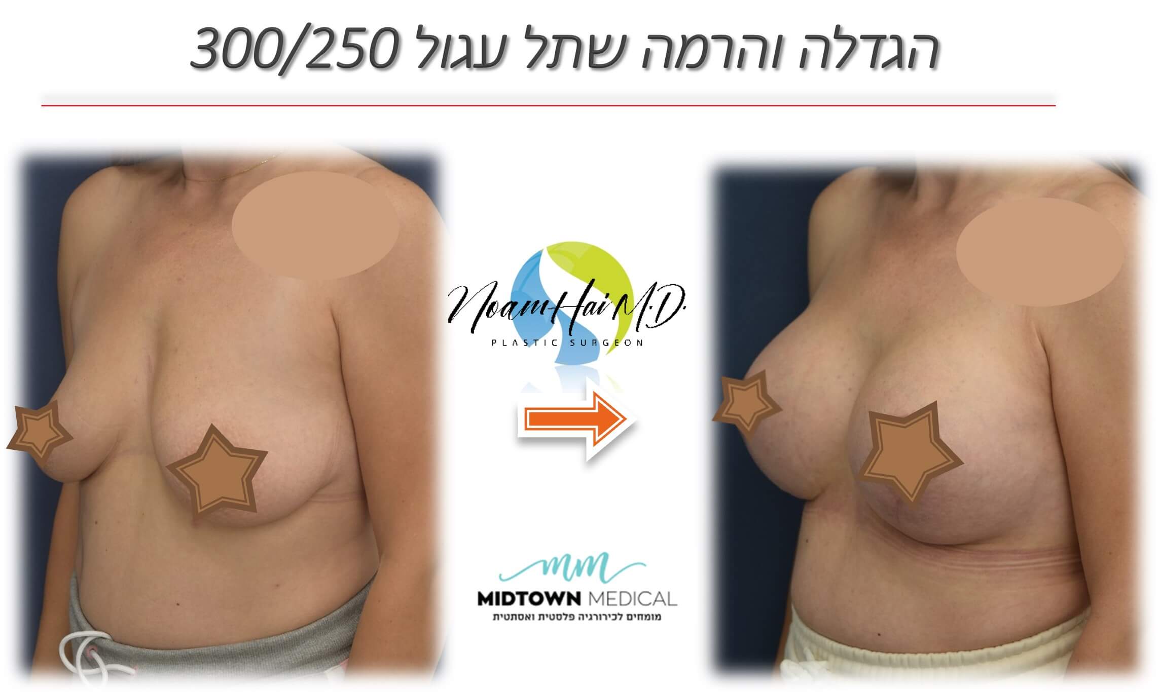 הגדלה והרמה שתל עגול 250-300