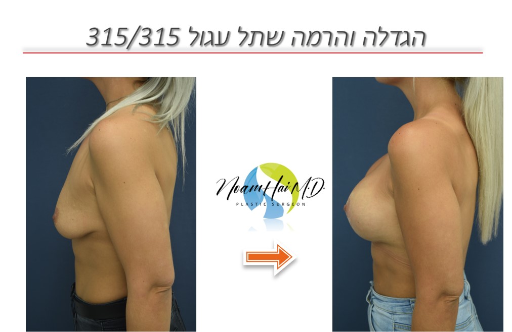 הגדלה והרמה שתל עגול 315