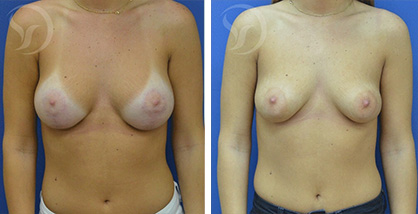 הגדלה והרמת חזה – תמונות