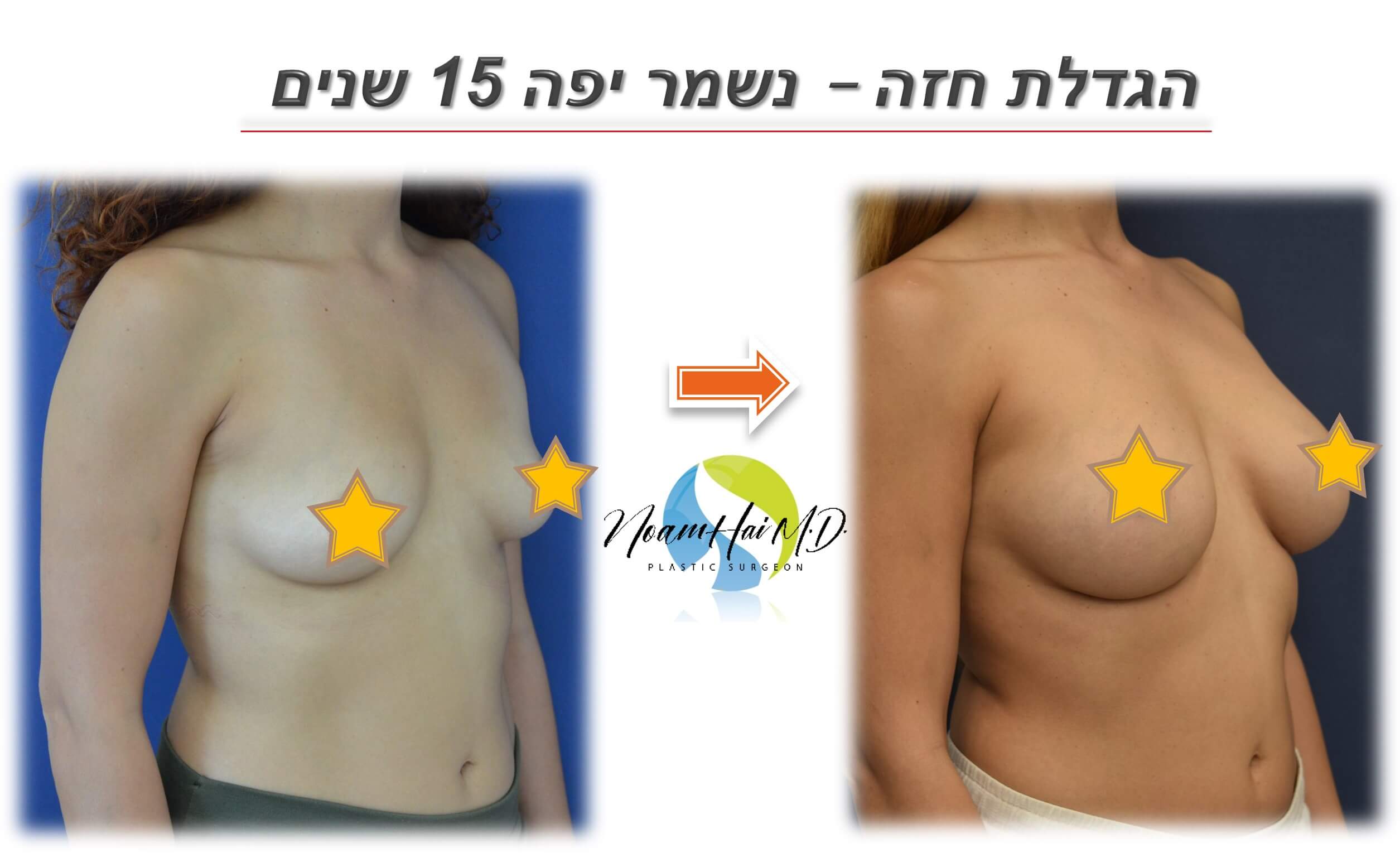 הגדלת חזה 10 לפני אחרי