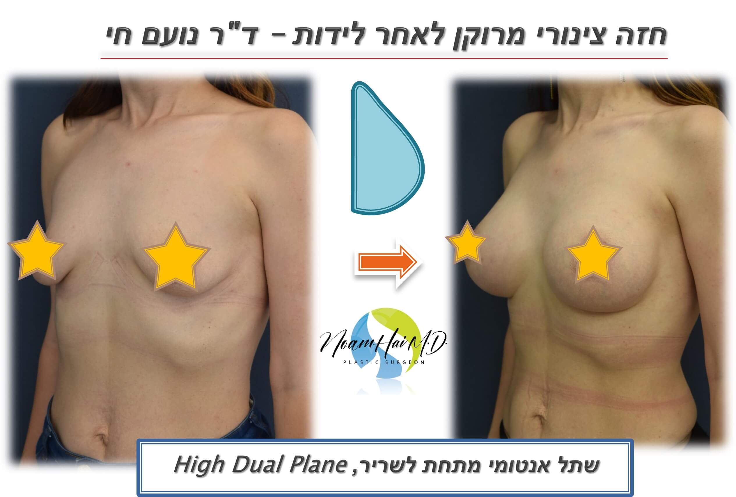 הגדלת חזה 30 לפני אחרי