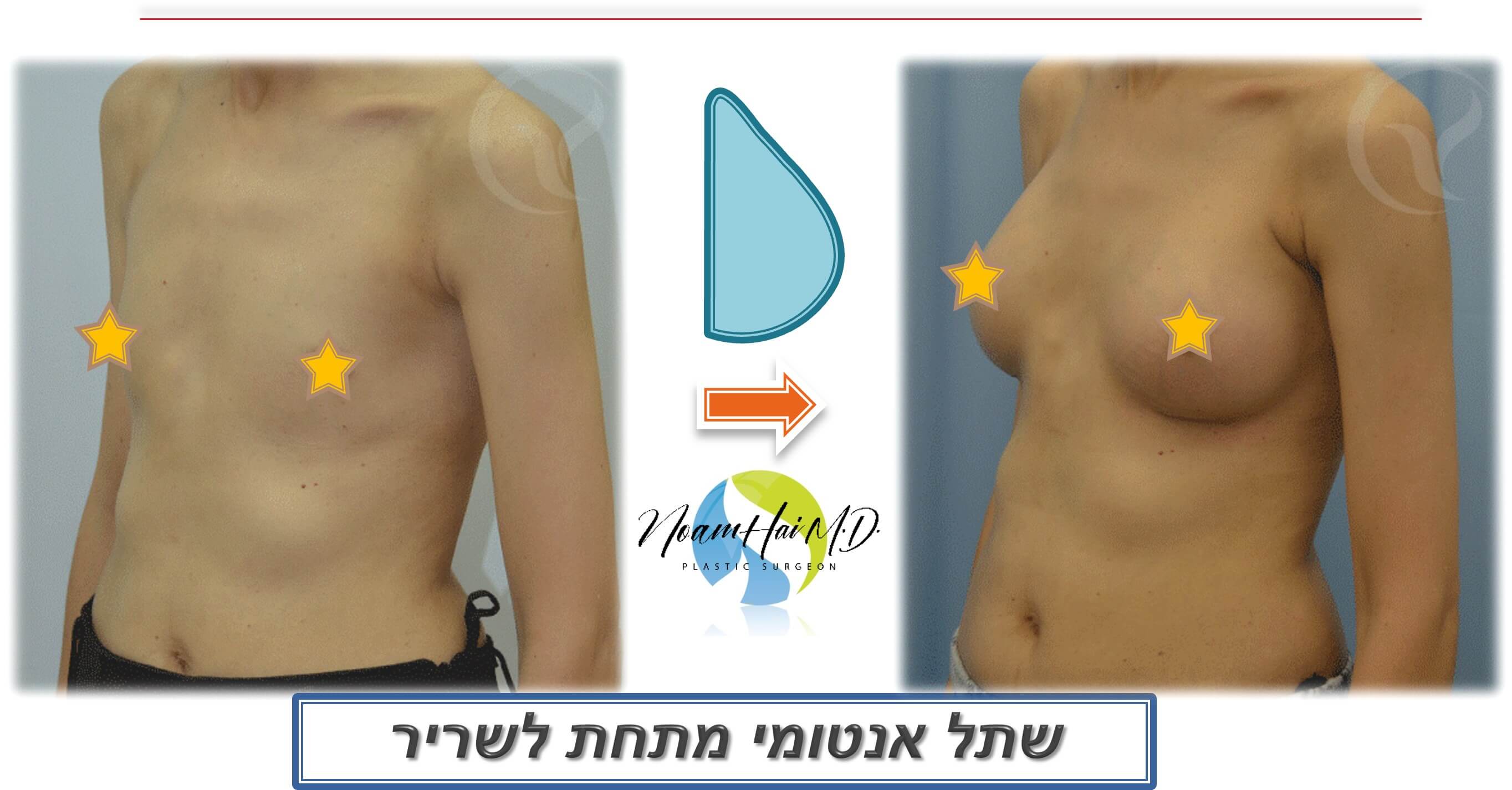 הגדלת חזה מתחת לשריר 40 לפני אחרי