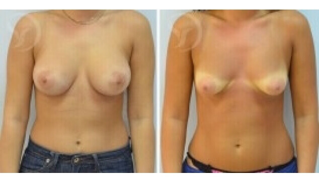 הגדלת חזה בשדיים צינוריים