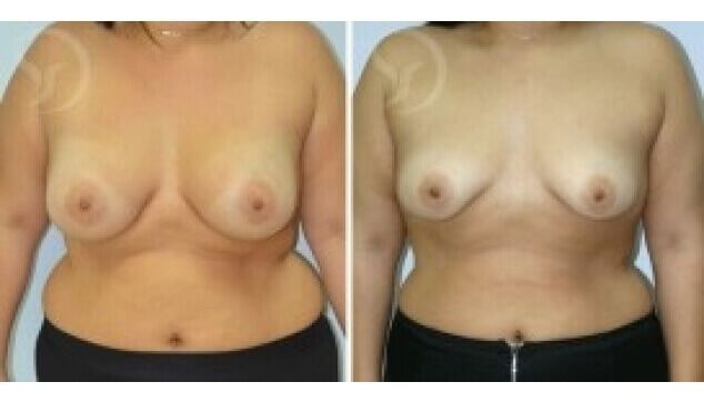 הגדלת חזה בשדיים צנוחים
