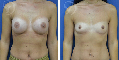 הגדלת חזה לפני אחרי