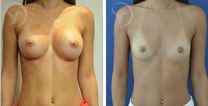 הגדלת חזה שתל אנטומי לפני אחרי