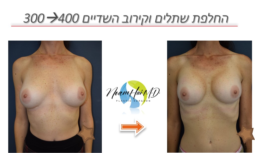 החלפת-שתלים-וקירוב-השדיים