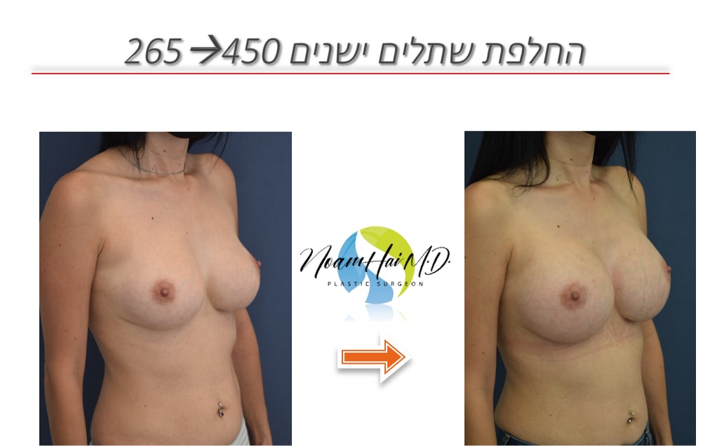 החלפת-שתלים-ישנים-265-ל-450