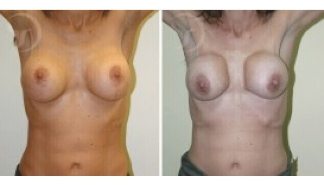 החלפת שתלים – לפני ואחרי