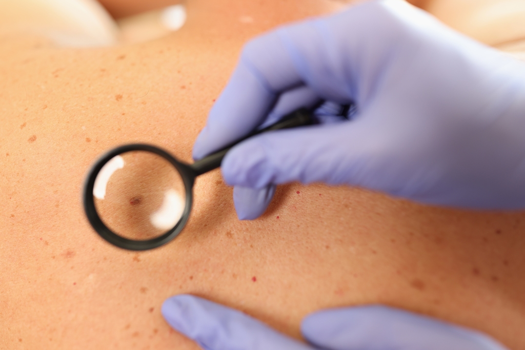 הסרת נקודות חן