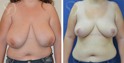 הקטנת חזה תמונות