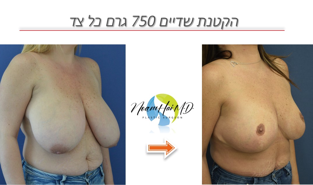 הקטנת שדיים 750 גרם כל צד