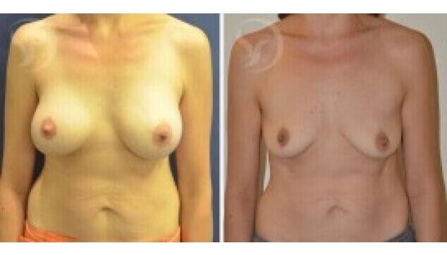 הרמת חזה ללא צלקות – תמונות