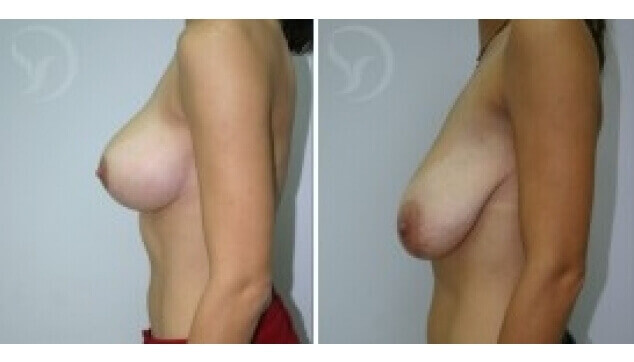 הרמת חזה תמונות