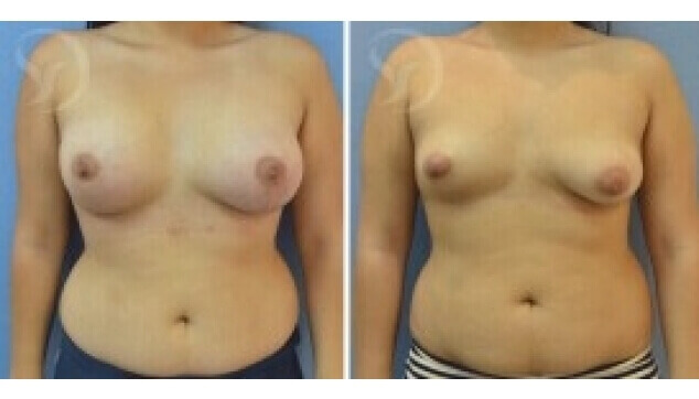 חזה אסימטרי תמונות