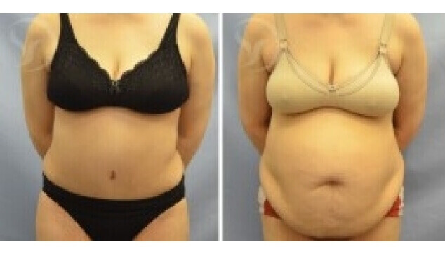 מתיחת בטן – תמונות