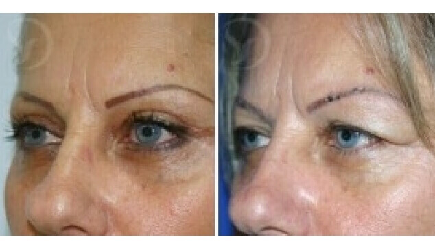 מתיחת עפעפיים – לפני ואחרי