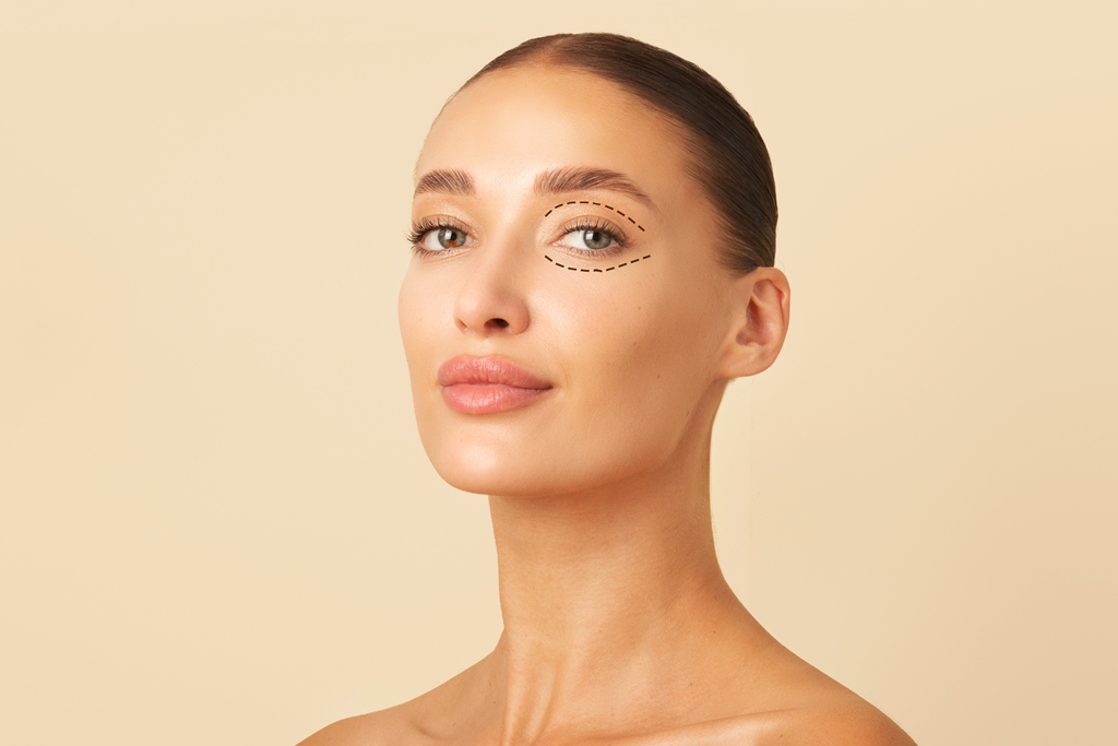 מתיחת עפעפיים