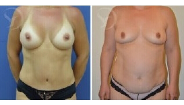 ניתוחים משולבים - חזה ובטן