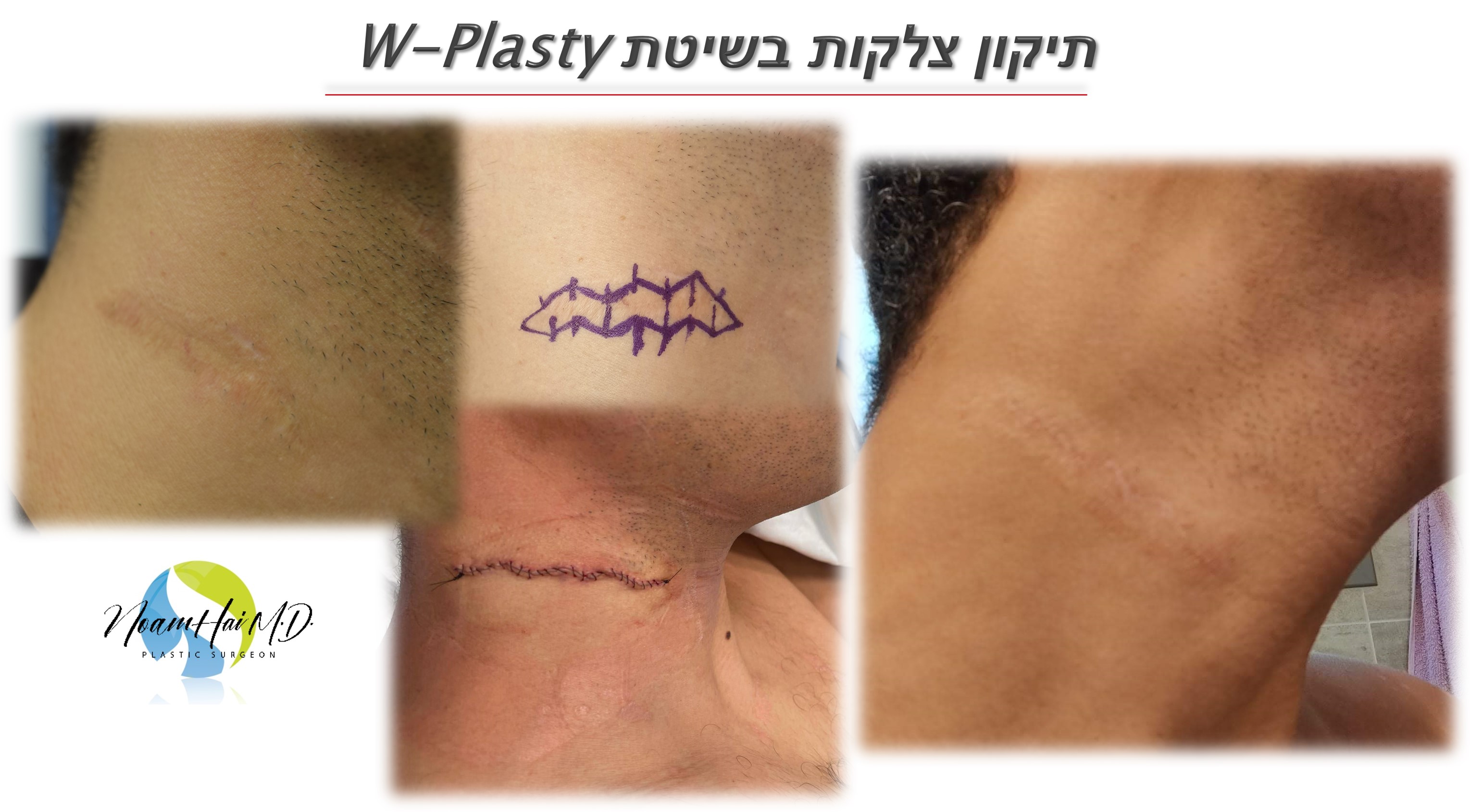 תיקון צלקות בשיטת w-plasty