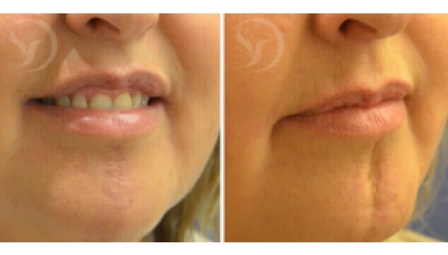 תיקון צלקות